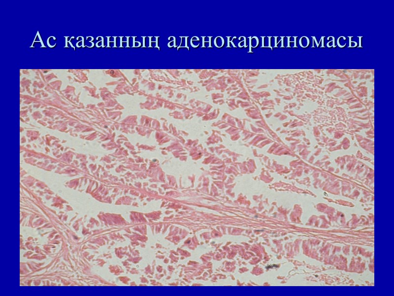 Ас қазанның аденокарциномасы